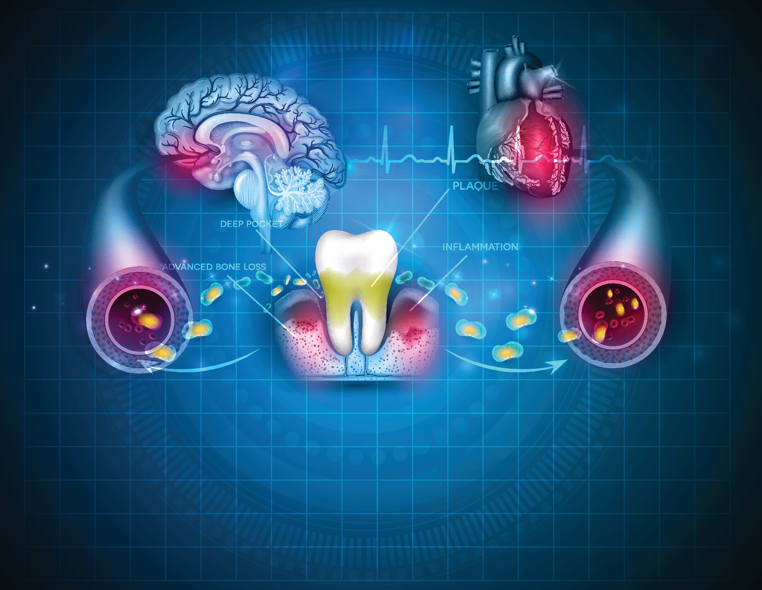 Study Links Gum Disease and Caries to Higher Stroke Risk | Inside ...